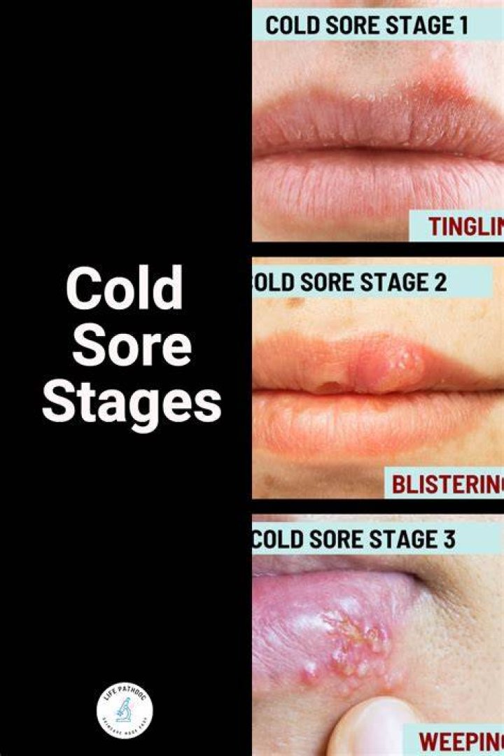 Do You Pop a Cold Sore Blister? Everything You Need to Know